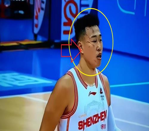 触目惊心!打了一场CBA比赛,整张脸都被“毁容”了球迷:可怕