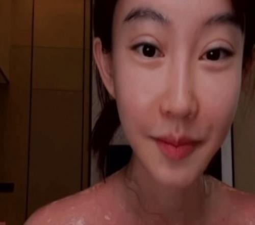 馮提莫戶外直播被嚴重曬傷！大方展示胸前大片紅腫