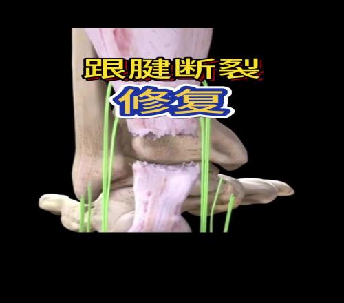 看着都疼啊！科普帖：球员脚跟腱断裂是如何进行修复的