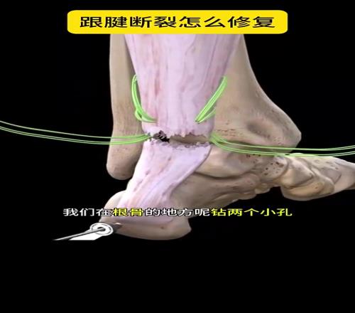 看着都疼啊科普帖：球员脚跟腱断裂是如何进行修复的