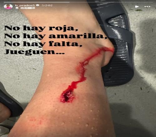 被林德洛夫出球后踹到小腿，毕尔巴鄂中场晒伤口：没红黄牌没犯规