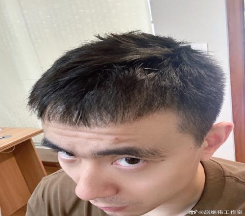 工作室晒赵继伟头&喉咙针灸图片：嗓子治疗进入下一阶段加油