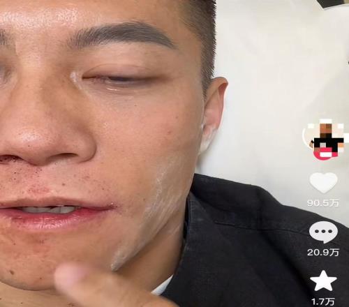 扇耳光大赛倒地的中国选手再发声：眼睛不时疼痛，仍希望参赛