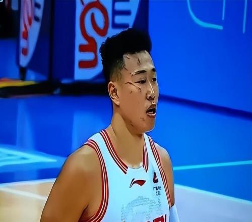 CBA真硬汉！脸部受伤眼都肿了还在场上拼，媒体和球迷：令人敬佩